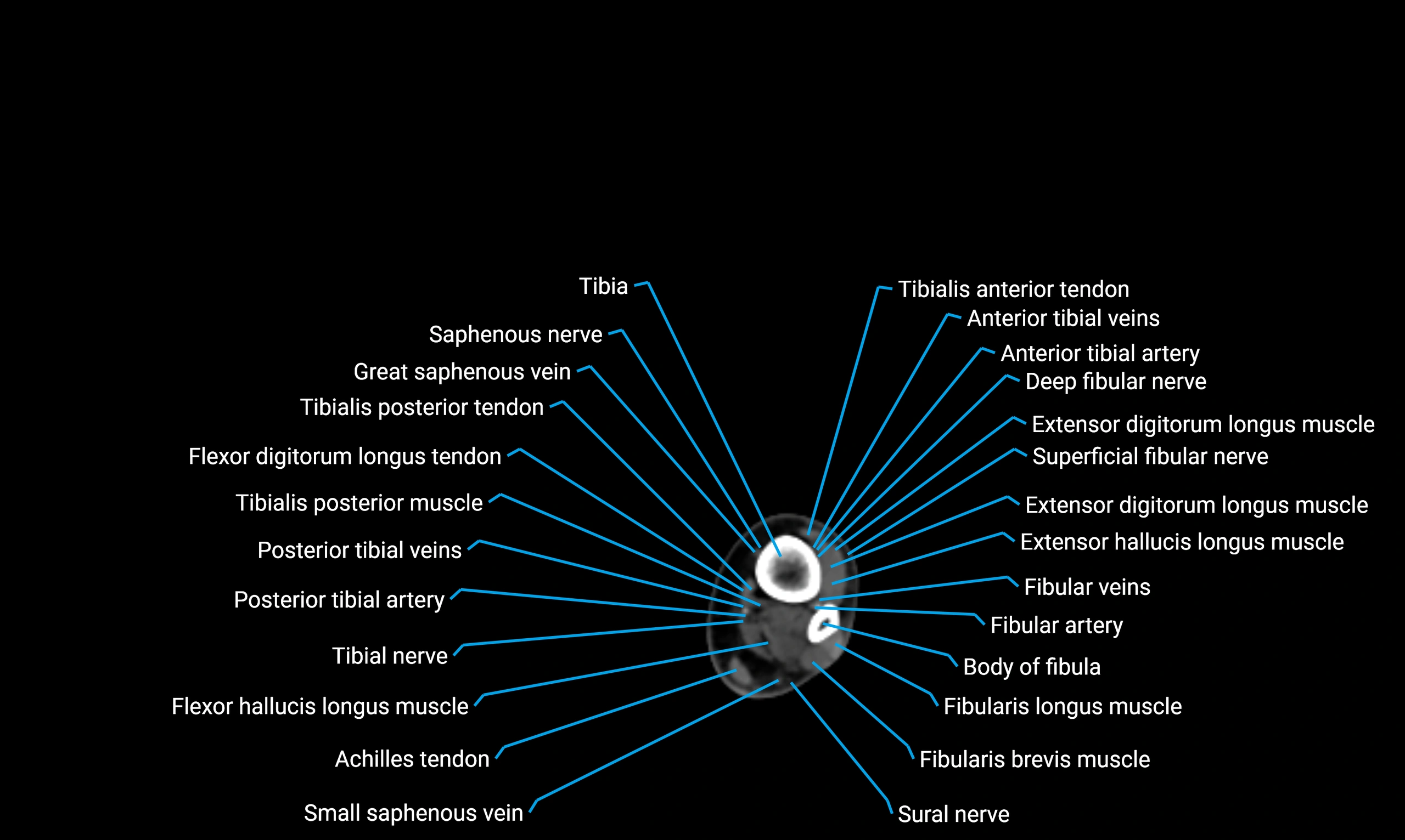 CT lower limb axial cross sectional anatomy labelled image 157 (2).webp